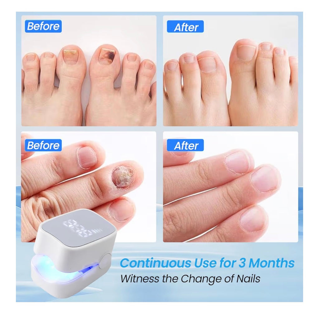 Nail Fungus Laser Device,