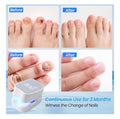 Nail Fungus Laser Device,